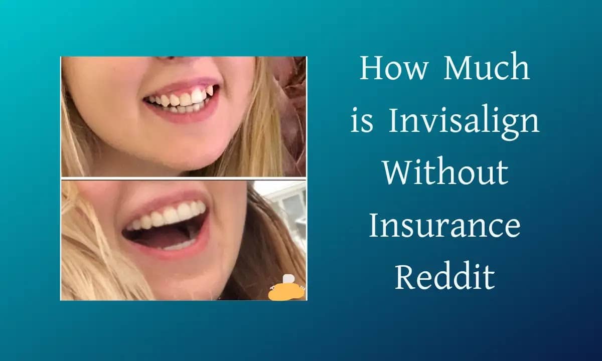 How Much is Invisalign Without Insurance Reddit 2026