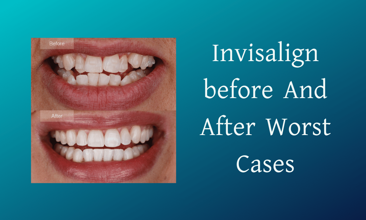 Invisalign before And After Worst Cases 2026